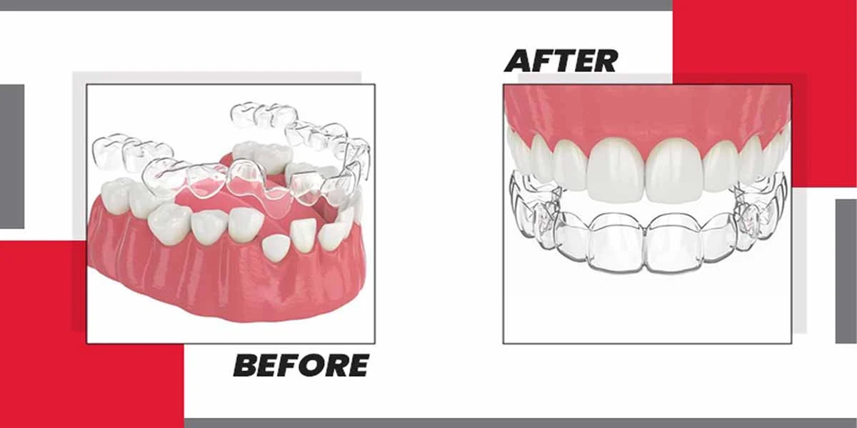 clear aligners before and after results 